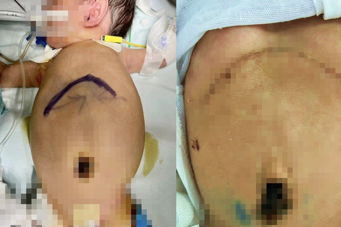 khoi-u-mau-o-gan-hiem-gap.jpg