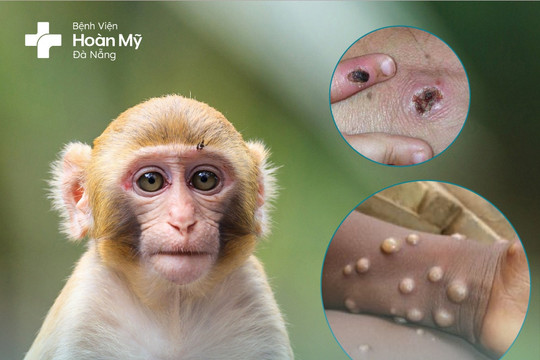 Những điều nên biết về bệnh đậu mùa khỉ
