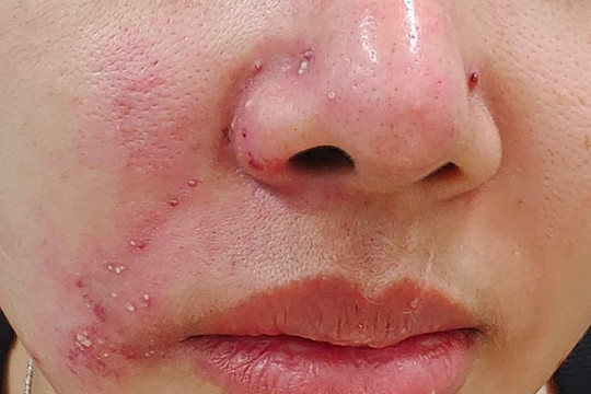 Mặt bị chảy mủ, nhiễm virus mụn rộp Herpes sau khi tiêm filler