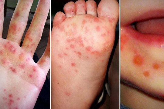 Sở Y tế TP.HCM: Virus gây tay chân miệng nặng ở trẻ em đã quay lại