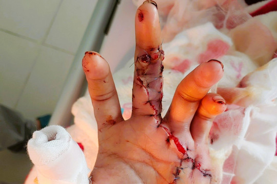Bệnh viện Quân y 175: Thực hiện vi phẫu ghép lại hai ngón tay bị đứt lìa hoàn toàn