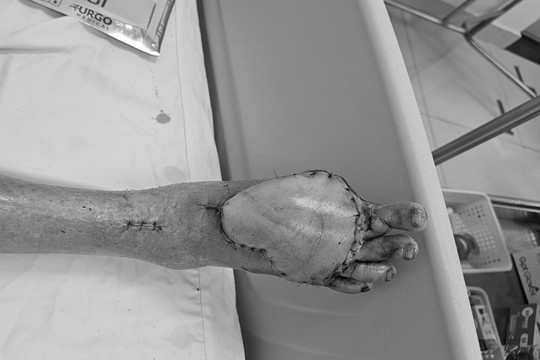 Chuyển vạt da vi phẫu cứu bệnh nhân U90 bị mất da toàn bộ mu bàn chân