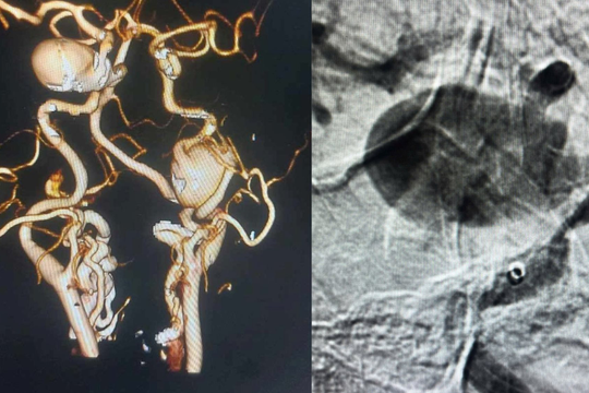 Can thiệp nội mạch cứu 2 bệnh nhân có túi máu phình khổng lồ ở não