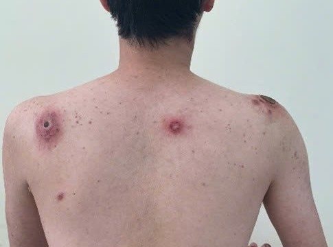 Bệnh viện Bệnh Nhiệt đới TP.HCM cảnh báo “vết loét nhỏ, hệ lụy khôn lường” vì giang mai