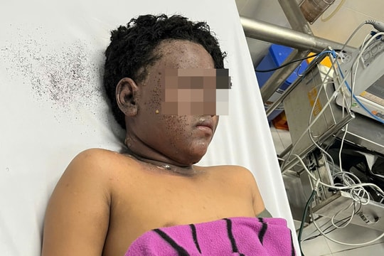 Bệnh viện Nhi đồng 2 cảnh báo: "Gần Tết, tai nạn pháo tự chế ở trẻ em gia tăng"