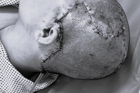 Phục hồi thẩm mỹ và chức năng vùng đầu do sẹo rộng vùng sọ sau bơm mỡ tự thân