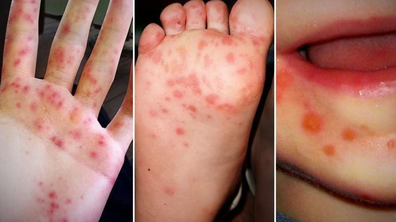Sở Y tế TP.HCM: Virus gây tay chân miệng nặng ở trẻ em đã quay lại