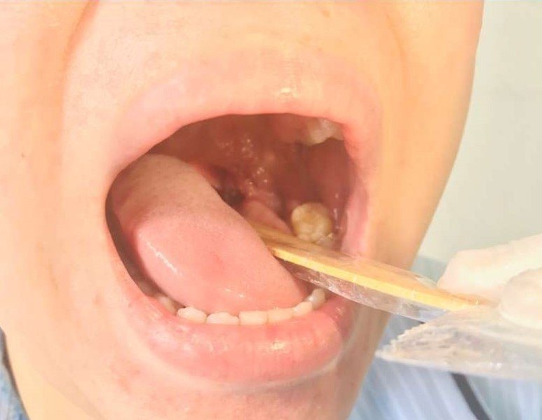 TP.HCM tăng cường giám sát, phòng chống đậu mùa khỉ