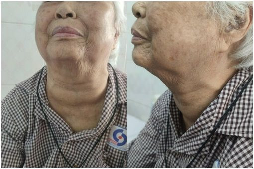 Phẫu thuật thành công cho người bệnh 95 tuổi có bướu cổ khổng lồ chèn ép khí quản