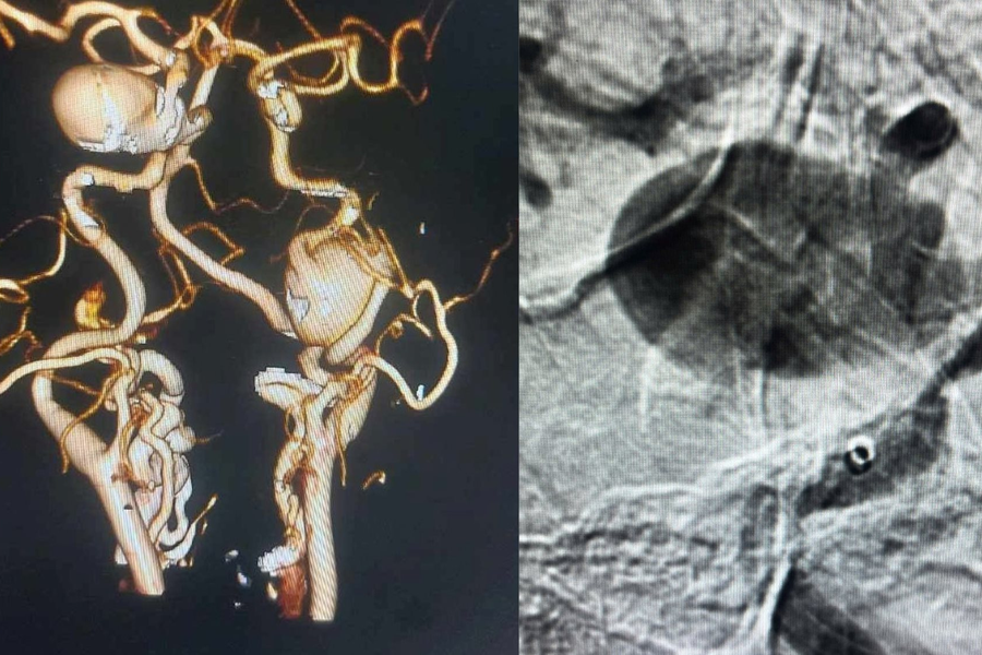 Can thiệp nội mạch cứu 2 bệnh nhân có túi máu phình khổng lồ ở não