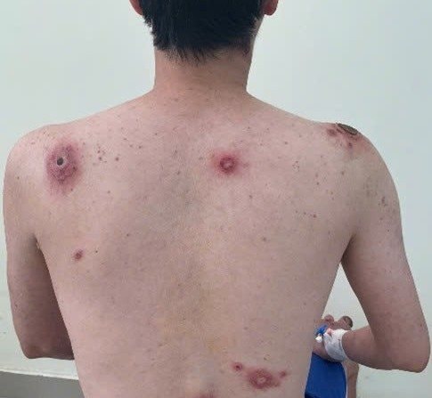 Bệnh viện Bệnh Nhiệt đới TP.HCM cảnh báo “vết loét nhỏ, hệ lụy khôn lường” vì giang mai