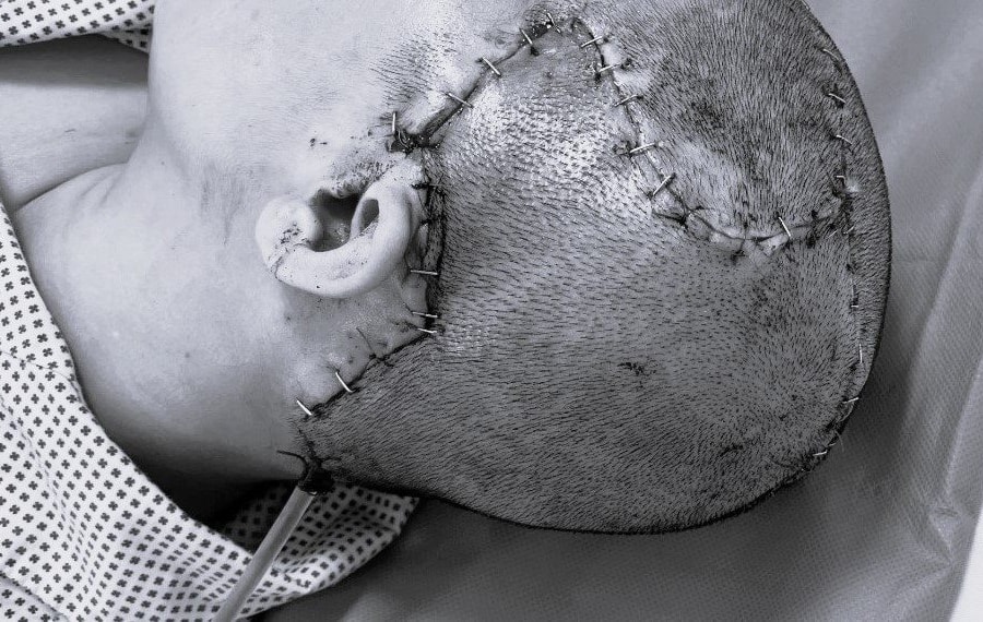 Phục hồi thẩm mỹ và chức năng vùng đầu do sẹo rộng vùng sọ sau bơm mỡ tự thân