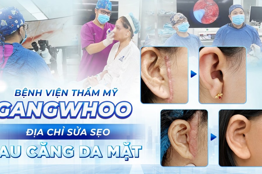 Bệnh viện Thẩm mỹ Gangwhoo – Địa chỉ sửa sẹo sau căng da mặt